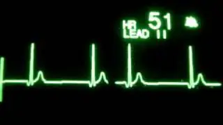Junctional Escape Rhythm, Junctional Rhythm, Idiojunctional Rhythm