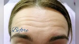 Botox (Allergan) 💉
