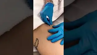 Seduta di Carbossiterapia Total Body