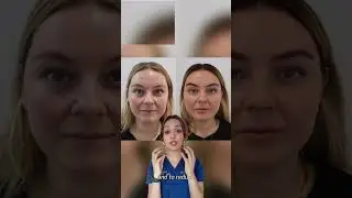SCULPTRA lift before and after pt1