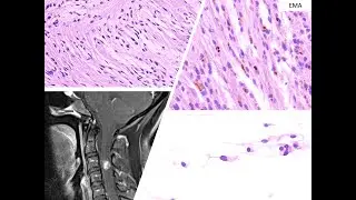 EPENDIMOMA TANICITICO | NEUROPATOLOGIA | CMNSXXI | IMSS | UNAM | SECIHTI