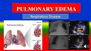PULMONARY EDEMA - Definition, types, causes, pathophysiology, symptoms , diagnoses , medicine