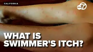 Swimmer's itch plagues people seeking relief from heat