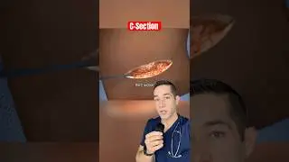 Lekarz wyjaśnia: cesarskie cięcie