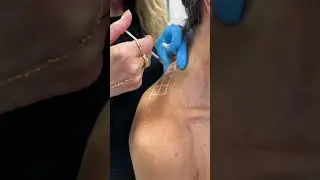 Say goodbye to tension and hello to elegance! Trap TOX&mdash;aka Barbie Botox #traptox #botox #medspa