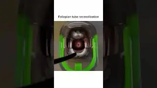 Fallopian tube recanalization🧐😮🤯 #learning #surgeryeducation