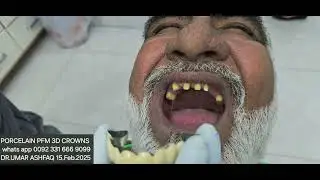 Porcelain dental covers teeth computerized laser cut  (PFM 3D)