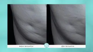 NeriumFirm Contour Cream to Reduce Cellulite and Dimpling
