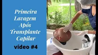 Dia da Lavagem - Transplante Capilar - 3ºdia - Vídeo 4