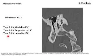 CT Inner ear: Normal Coronal By Level