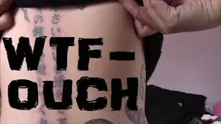 My Laser Tattoo Removal Experience 2x