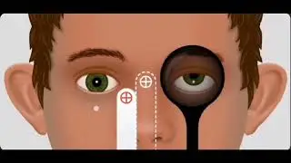 Dissociated vertical deviation||DVD||Strabismus||Ophthalmology||Squint