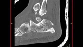 Musculoskeletal: Calcaneus fracture: Sagittal