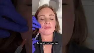 Duo treatment. Sculptra Rejuvenating and PDO lifting threads. Elite Medical Spa. #shorts