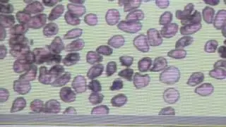 Peripheral blood smear of Babesia in an anemic poodle