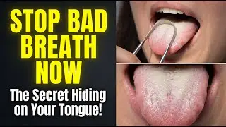 Tongue Coating: What It Is and How to Prevent Bad Breath