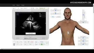 SUBCOSTAL VIEW OF THE INFERIOR VENA CAVA