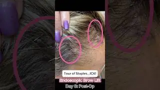 Endoscopic Brow Lift - Day 8: Post-Op (Tour of Staples)