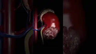 किडनी कैसे खराब होती है?How Kidneys Get Damaged in! Easy-to-Understand Animated Explanation