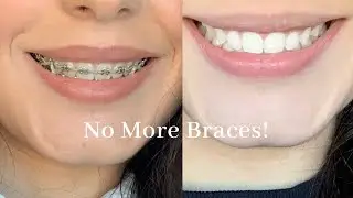 Getting My Braces Removed
