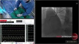 CTO of RCA Using Antegrade Approach