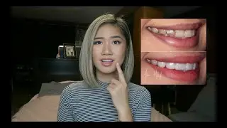 FINALLY GOT PORCELAIN VENEERS & 6 MONTHS UPDATE/REVIEW | PART 3 | itzalyssaaa