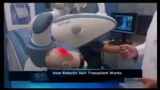 ARTAS Robotic Hair Restoration Featured on The Doctors | (416)-747-7873| Toronto, Canada