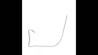 Mental Foramen