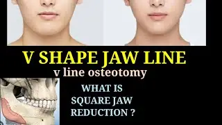 V SHAPE JAW LINE SURGERY INDIA INDORE MUMBAI DELHI HYDERABAD BANGALORE KOLKATA LUCKNOW AHMEDABAD