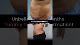 Unbelievable 2 Months Tummy Tuck Transformation! | Tummy Tuck Surgery in Delhi #tummytuck