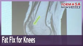 Taichung hospital repairs knees using patient&rsquo;s own fat tissue