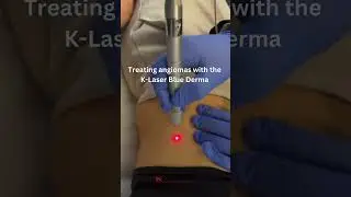Angioma removal with K-Laser. One treatment required. #laser