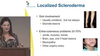 Scleroderma 101 - 2018 Patient Education Day