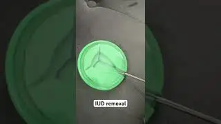 IUD removal