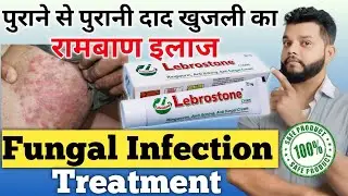 दाद खुजली का रामबाण इलाज | Fungal Infection Treatment | Lebrostone Cream Review