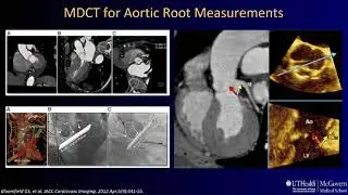 Echocardiography for Aortic Stenosis in the TAVR Era