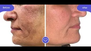 Transform Your Skin with Youlaser MT: Advanced Treatment for Skin Tone, Scars, Acne, and More!