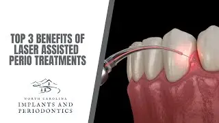 Top 3 Benefits of Laser Assisted Periodontal Treatments