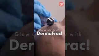 The Ultimate Skin Reboot: DermaFrac Glow Treatment #dermafrac #skincare #shorts