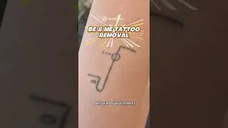 Ready to say Good bye to unwanted ink? 👋👋 #tattooremoval #laserremoval