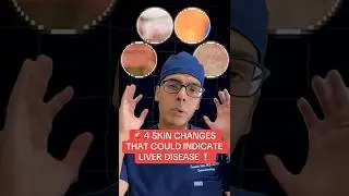 4 skin changes that could indicate liver disease ❗️