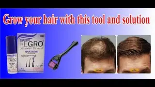 regrow hair spray use minoxidil spray