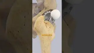 Hip Replacement Surgery Explained Step-by-Step