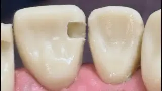 Class 3 cavity preparation ( dental video )