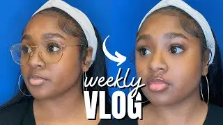 vlog: i got lip injections (black people get fillers too)