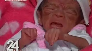 24 Oras: Premature baby na ubod nang liit, normal na ang kalagayan matapos ang 2 buwang gamutan