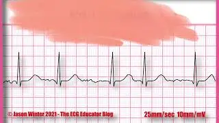 EKG Quiz: Identify the EKG rhythm/must know EKG/ECG Rhythms #quiz#ekg#ecg#rhythm#ekgrhythm#heart
