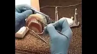Maxillary reline procedure