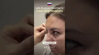 Puffy under-eyes made this Russian woman in her 40s look tired and older. 불룩한 눈밑과 늘 피곤해 보이는 40대 여성