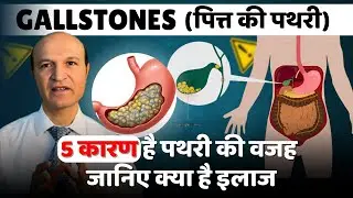 Ultrasound, CT या MRCP? | Gallstone की सबसे बेहतर जांच कौन सी है? Symptoms and investigations